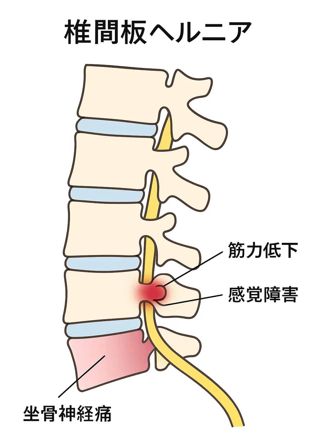 椎間板ヘルニア