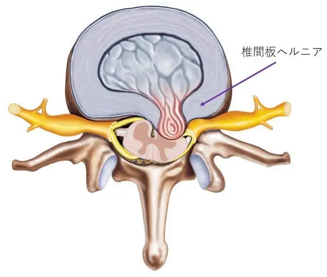 椎間板ヘルニア