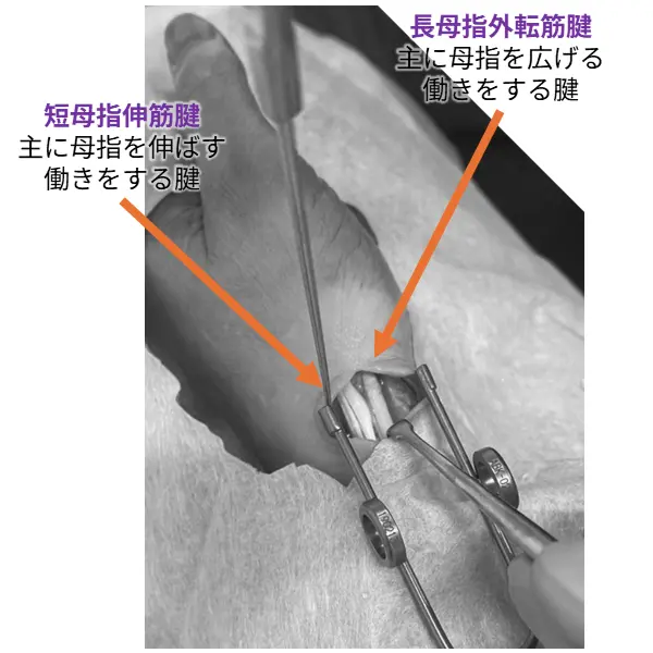 ドケルバン腱鞘炎
