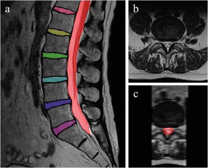腰部脊柱管狭窄症